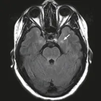 JAMA Neurology Author Interviews artwork