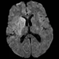 JAMA Neurology Author Interviews artwork