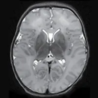JAMA Neurology Author Interviews artwork